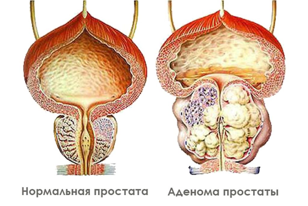 Гиперплазия предстательной железы картинки